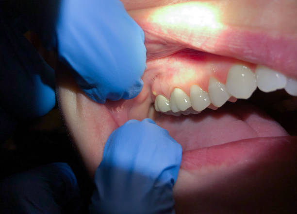 Best Emergency Tooth Extraction in Marysville, PA